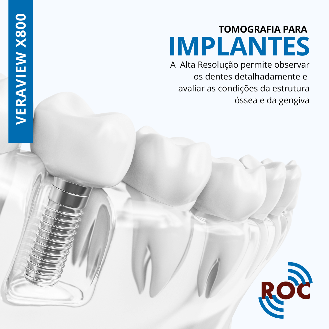 Ilustração de implantes dentários