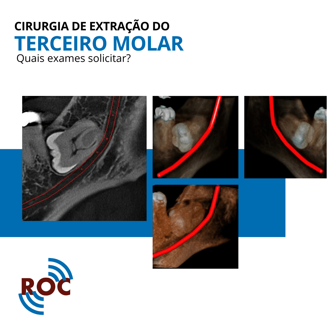 Imagens tomográfica de terceiro molar