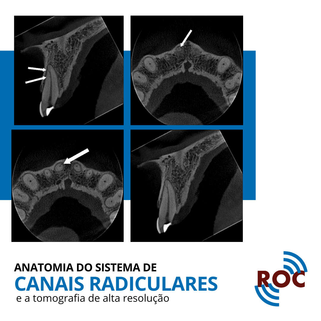 Imagens tomográficas da anatomia de um sistema de canais radiculares