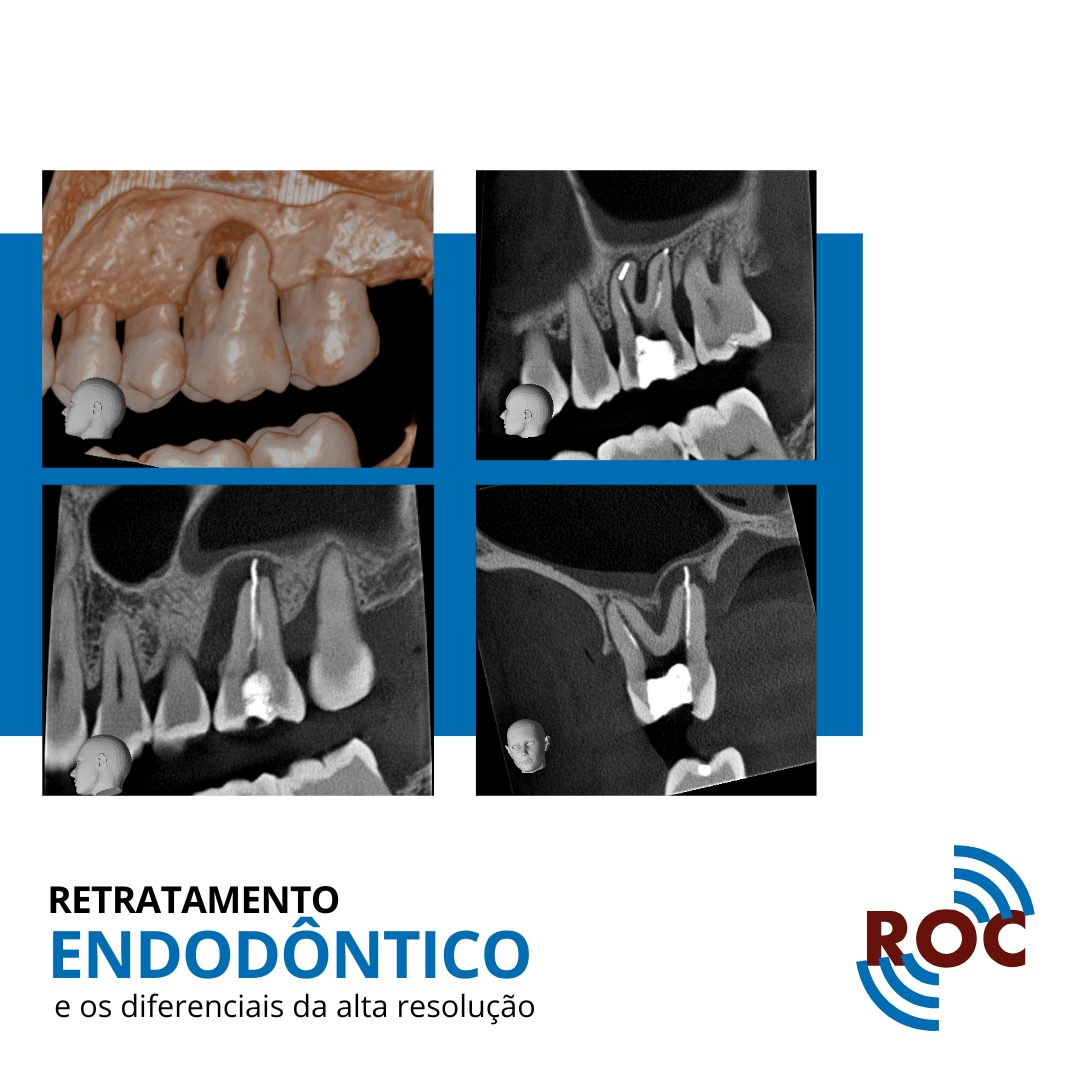 Imagens tomográficas de retratamento endodôntico