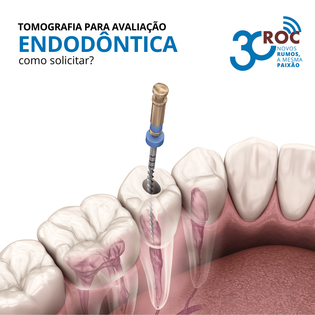 Ilustração de procedimento endodôntico