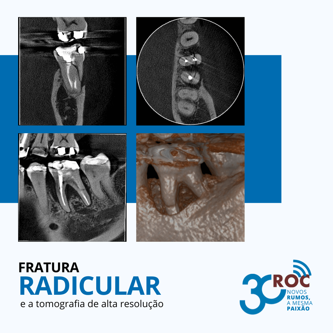 Imagens tomográficas de uma fratura radicular
