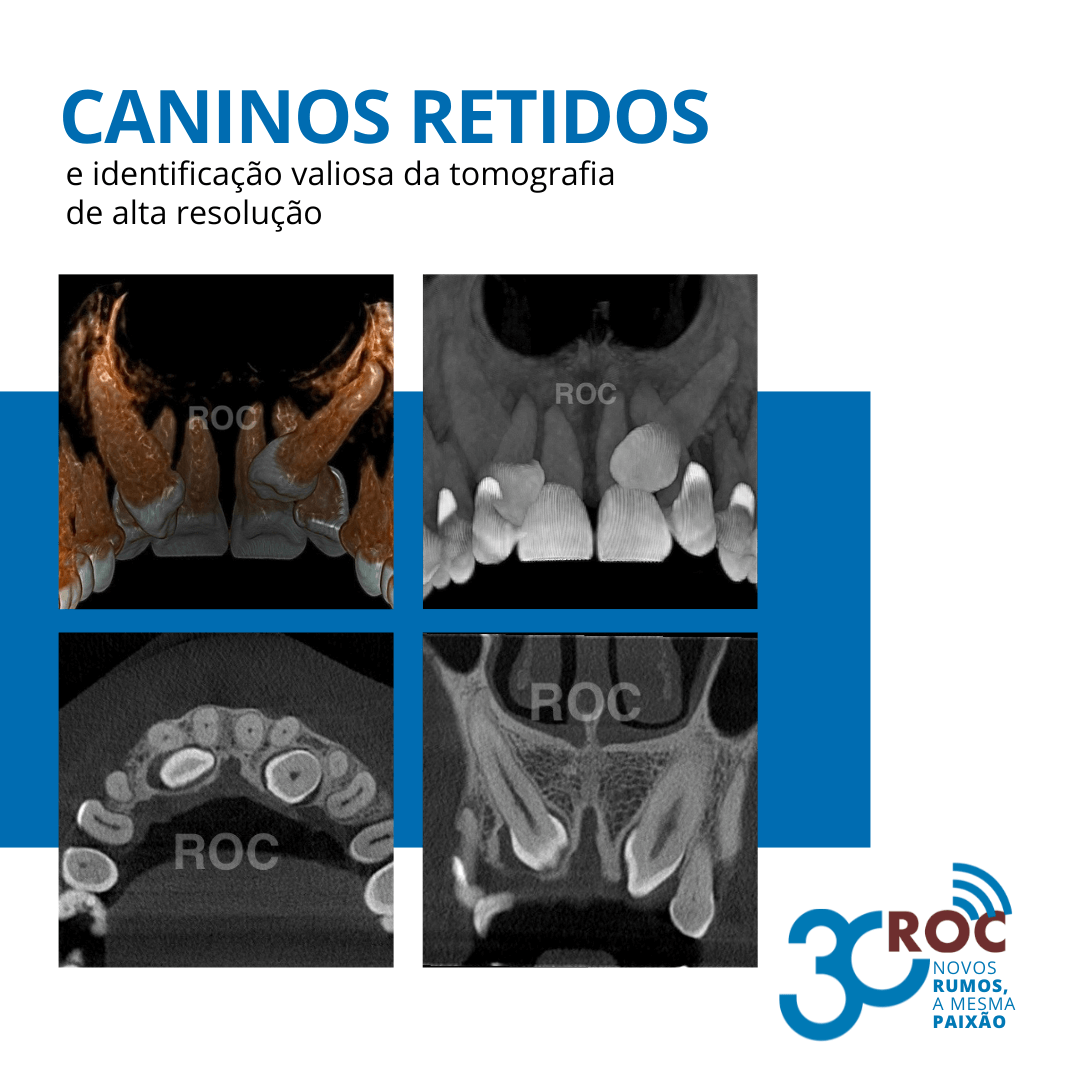 Imagens tomográficas de caninos retidos