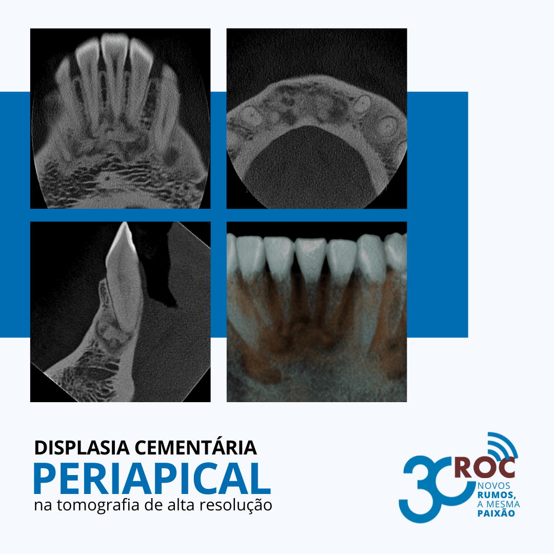 Imagens tomográficas apontando displasia cementária periapical