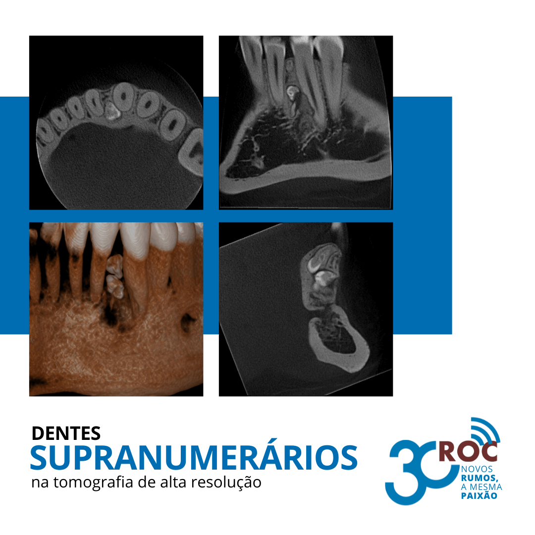 Imagens tomográficas revelando dentes supranumerários