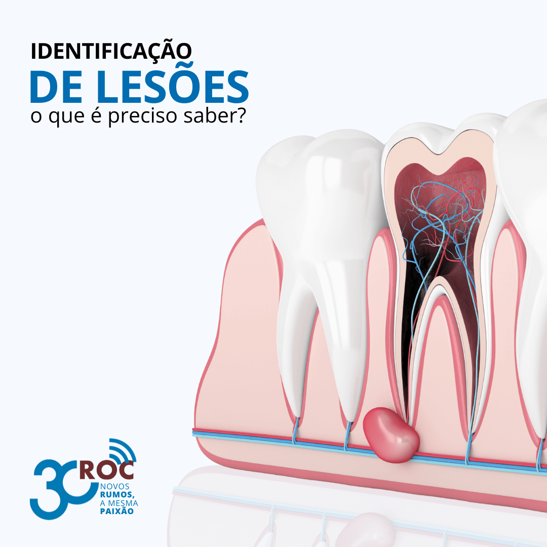 Ilustração de lesão interna entre os dentes