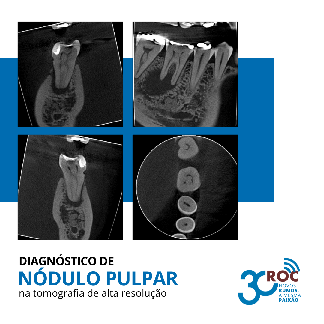 Imagens tomográficas de nódulo pulpar